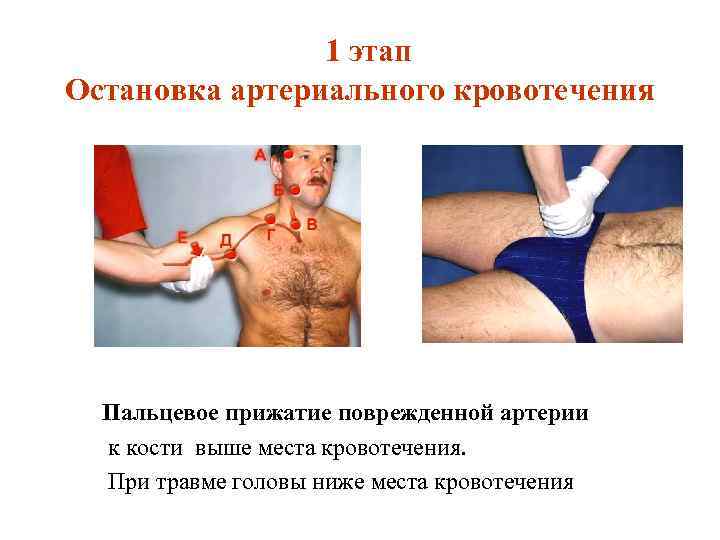  1 этап Остановка артериального кровотечения Пальцевое прижатие поврежденной артерии к кости выше места