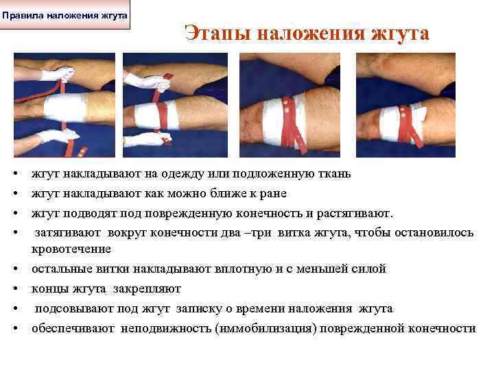 Правила наложения жгута • • Этапы наложения жгута жгут накладывают на одежду или подложенную