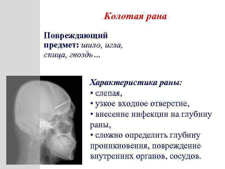 Колотая рана Повреждающий предмет: шило, игла, спица, гвоздь… Характеристика раны: • слепая, • узкое