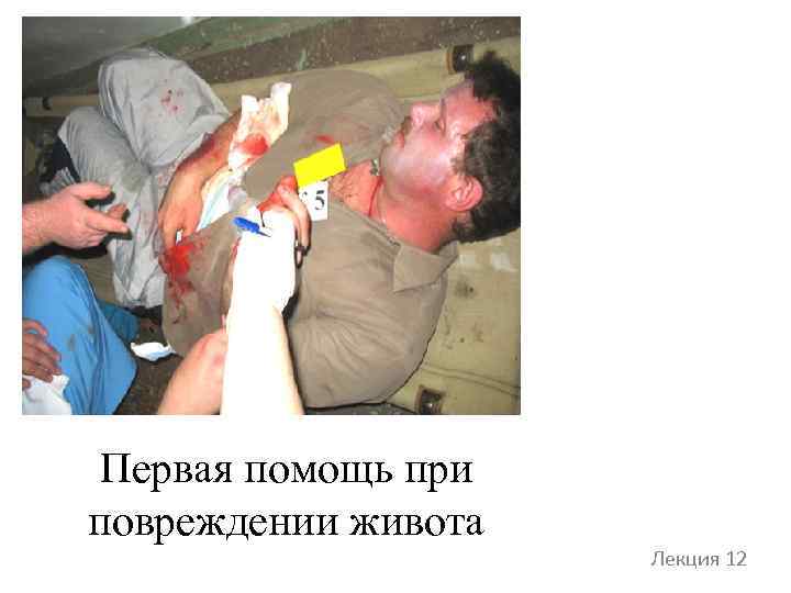 Первая помощь при повреждении живота Лекция 12 