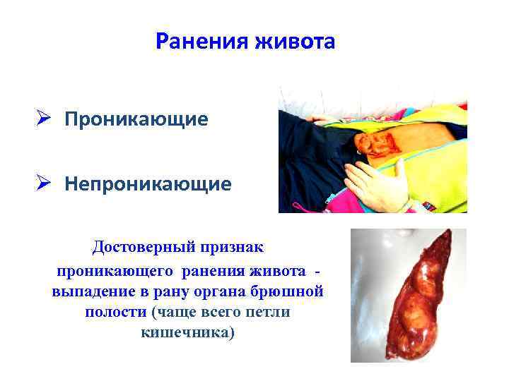 Ранения живота Ø Проникающие Ø Непроникающие Достоверный признак проникающего ранения живота выпадение в рану
