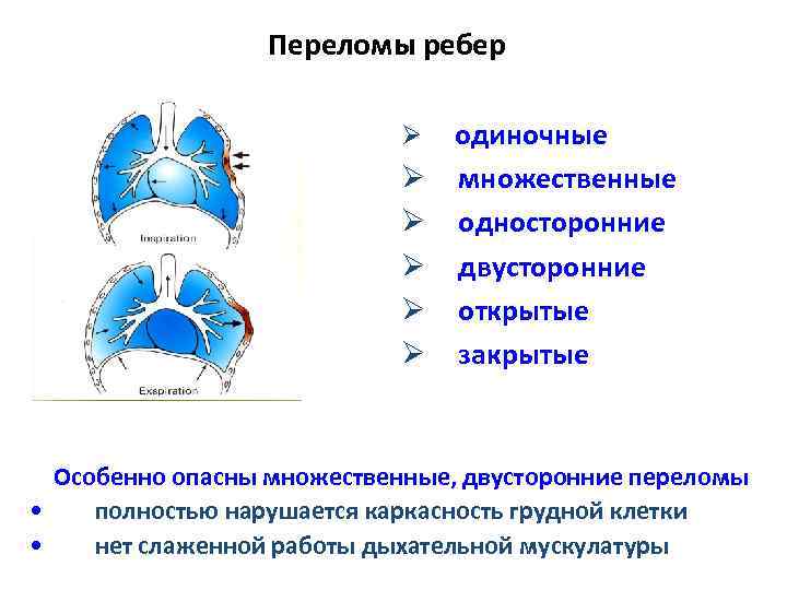 Закрытый перелом ребра карта вызова