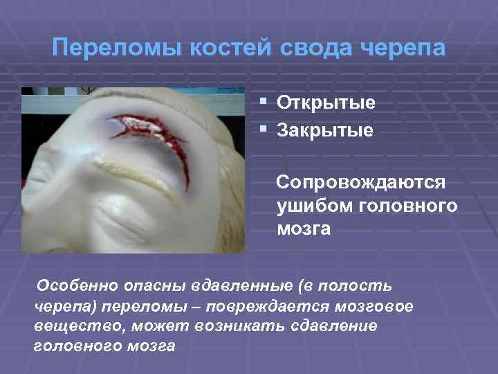 Переломы костей свода черепа § Открытые § Закрытые Сопровождаются ушибом головного мозга Особенно опасны