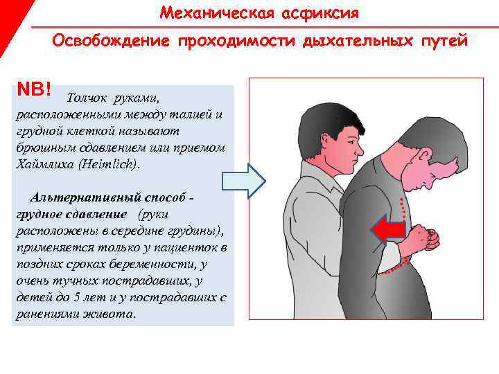 Механическая асфиксия Освобождение проходимости дыхательных путей NB! Толчок руками, расположенными между талией и грудной