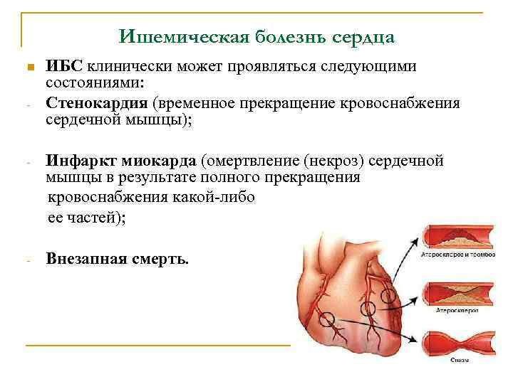 Ишемическая болезнь сердца n - ИБС клинически может проявляться следующими состояниями: Стенокардия (временное прекращение