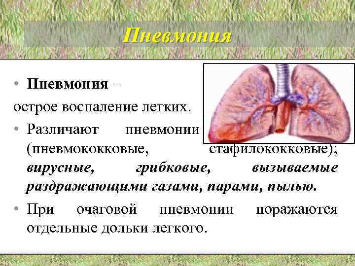 Пневмония • Пневмония – острое воспаление легких. • Различают пневмонии бактериальные (пневмококковые, стафилококковые); вирусные,