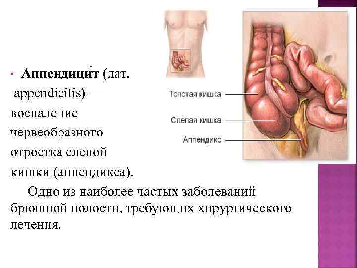 Аппендици т (лат. appendicitis) — воспаление червеобразного отростка слепой кишки (аппендикса). Одно из наиболее