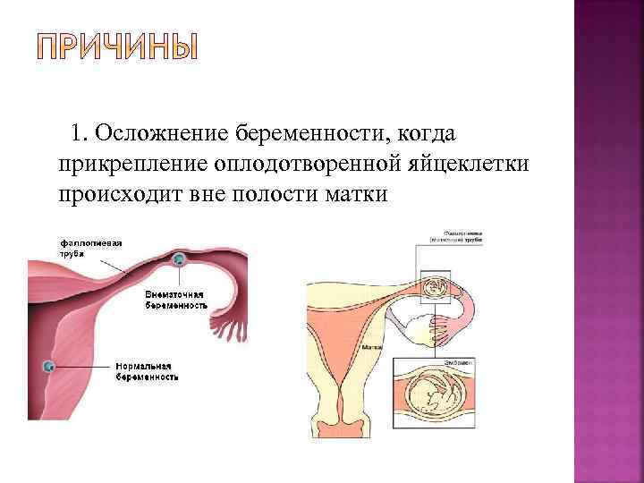 1. Осложнение беременности, когда прикрепление оплодотворенной яйцеклетки происходит вне полости матки 