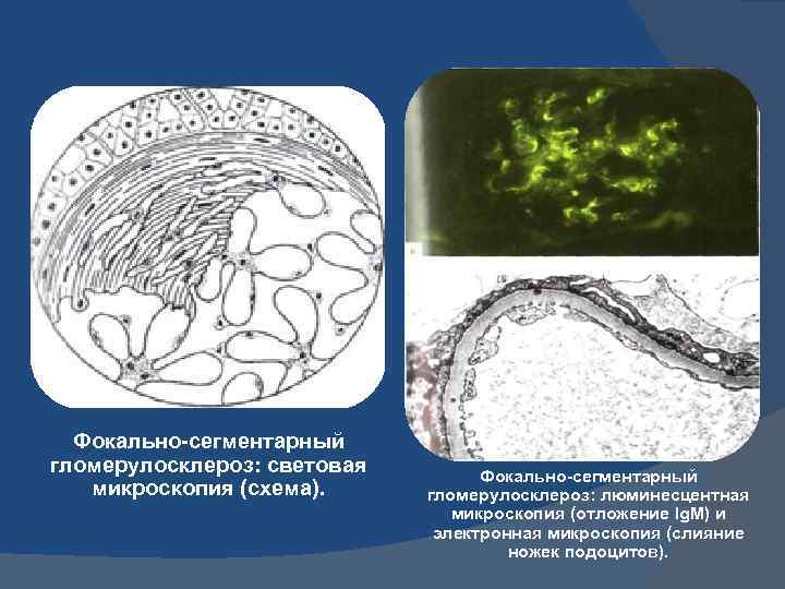 Фокально-сегментарный гломерулосклероз: световая микроскопия (схема). Фокально-сегментарный гломерулосклероз: люминесцентная микроскопия (отложение Ig. M) и электронная