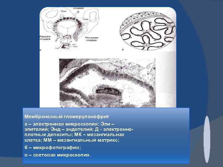 Мембранозный гломерулонефрит а – электронная микроскопия: Эпи – эпителий; Энд – эндотелий; Д -