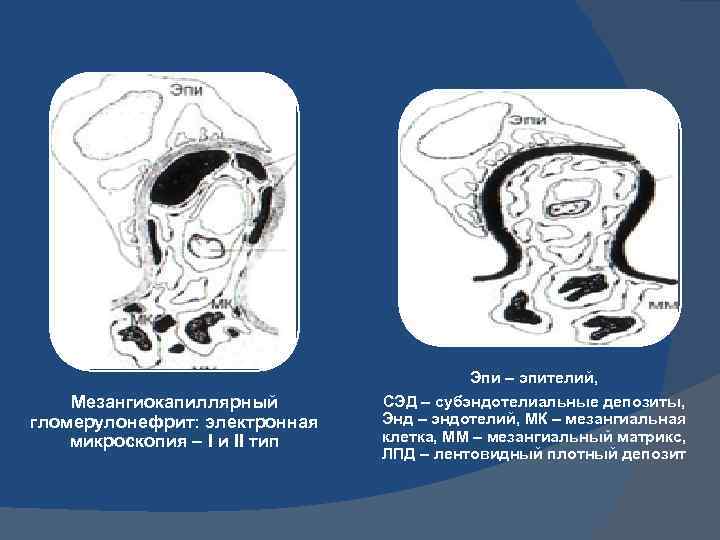 Эпи – эпителий, Мезангиокапиллярный гломерулонефрит: электронная микроскопия – I и II тип СЭД –