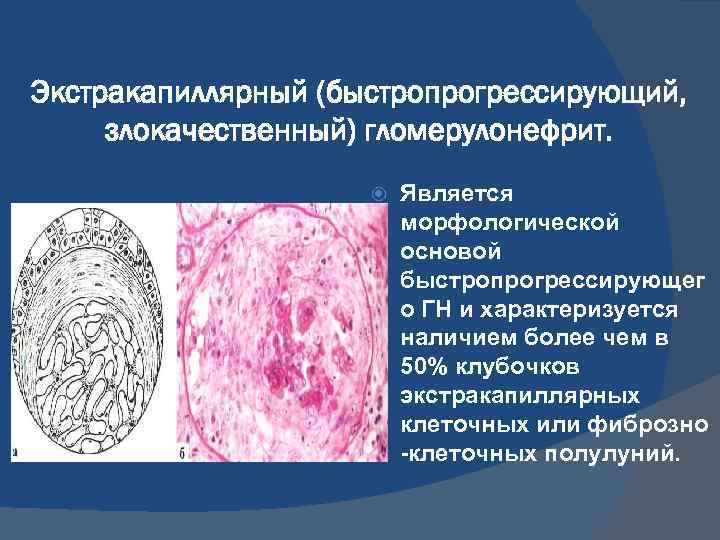 Микроскопическая картина мочи при гломерулонефрите