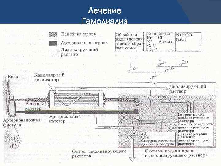 Лечение Гемодиализ 