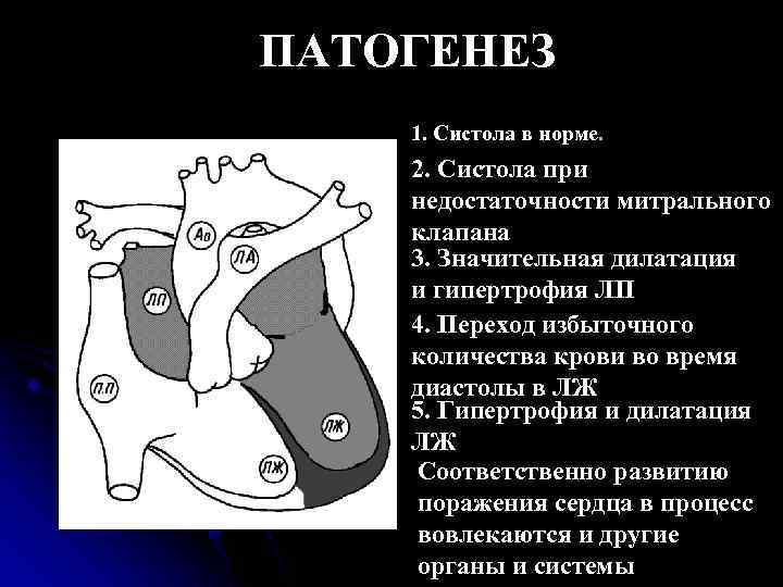 ПАТОГЕНЕЗ 1. Систола в норме. Ток крови 2. Систола при недостаточности митрального клапана 3.