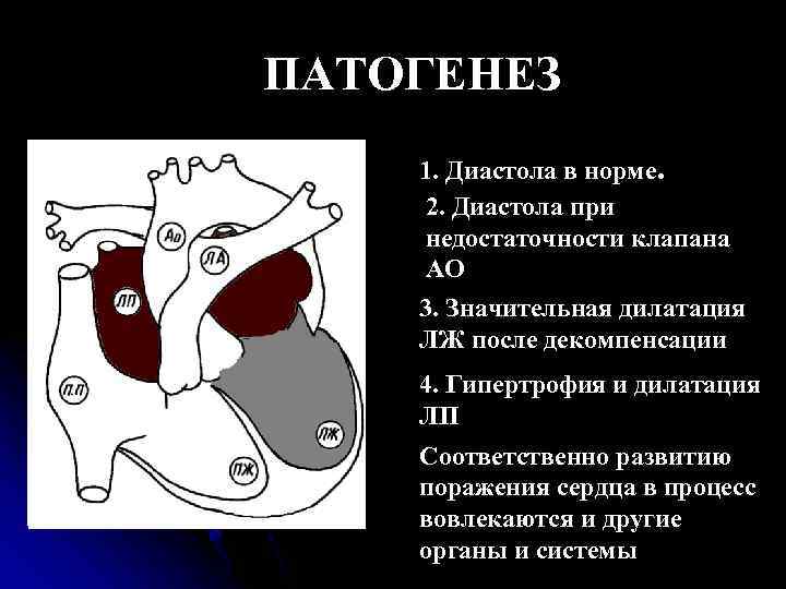 ПАТОГЕНЕЗ 1. Диастола в норме. 2. Диастола при недостаточности клапана АО 3. Значительная дилатация