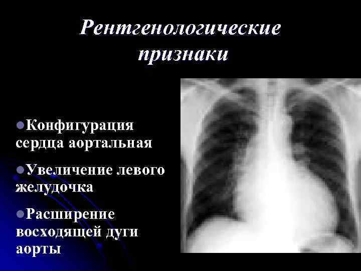 Рентгенологические признаки l. Конфигурация сердца аортальная l. Увеличение желудочка l. Расширение левого восходящей дуги