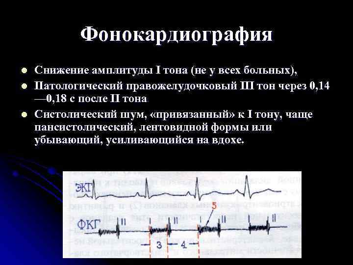 Фонокардиография l l l Снижение амплитуды I тона (не у всех больных), Патологический правожелудочковый