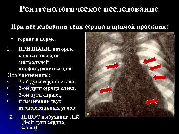 Границы расширены влево. Митральный стеноз рентген. Тень сердца расширена на рентгенограмме. Рентгенологическое исследование сердца. Конфигурация сердца при патологии.