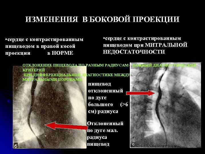 На основании сходной рентгенологической картины следует дифференцировать изменения пищевода при