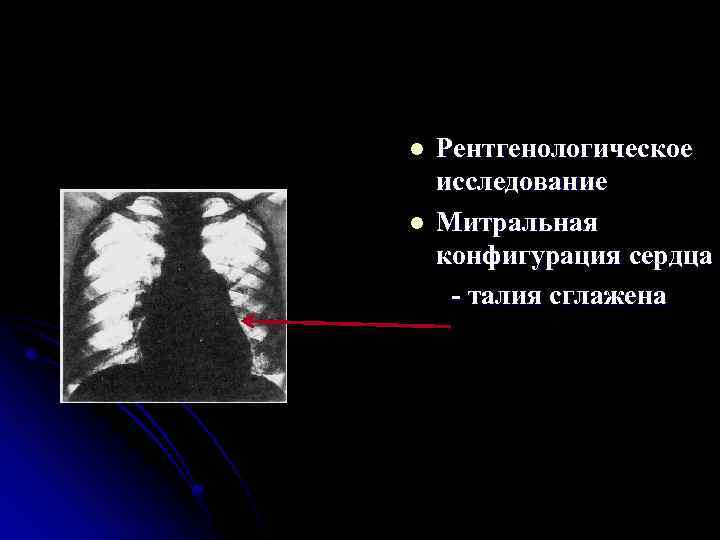 l l Рентгенологическое исследование Митральная конфигурация сердца талия сглажена 