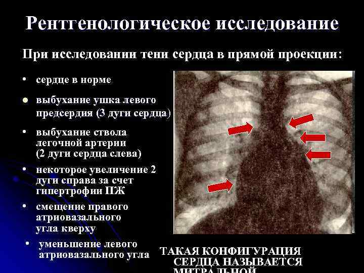 Рентгенологическое исследование При исследовании тени сердца в прямой проекции: • сердце в норме l