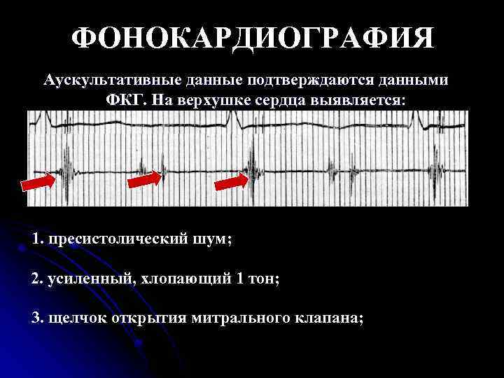 ФОНОКАРДИОГРАФИЯ Аускультативные данные подтверждаются данными ФКГ. На верхушке сердца выявляется: 1. пресистолический шум; 2.