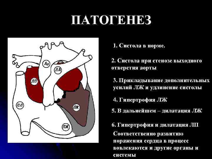 ПАТОГЕНЕЗ 1. Систола в норме. 2. Систола при стенозе выходного отверстия аорты 3. Прикладывание