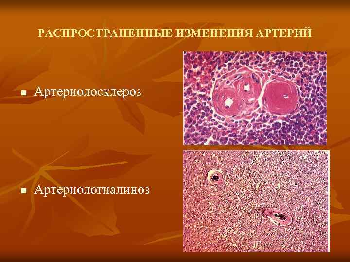 РАСПРОСТРАНЕННЫЕ ИЗМЕНЕНИЯ АРТЕРИЙ n Артериолосклероз n Артериологиалиноз 