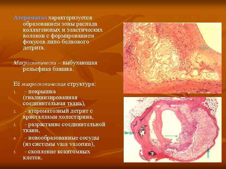 Атероматоз характеризуется образованием зоны распада коллагеновых и эластических волокон с формированием фокусов липо-белкового детрита.