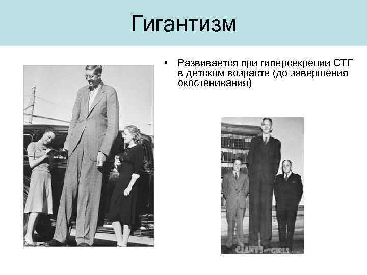 Гигантизм • Развивается при гиперсекреции СТГ в детском возрасте (до завершения окостенивания) 
