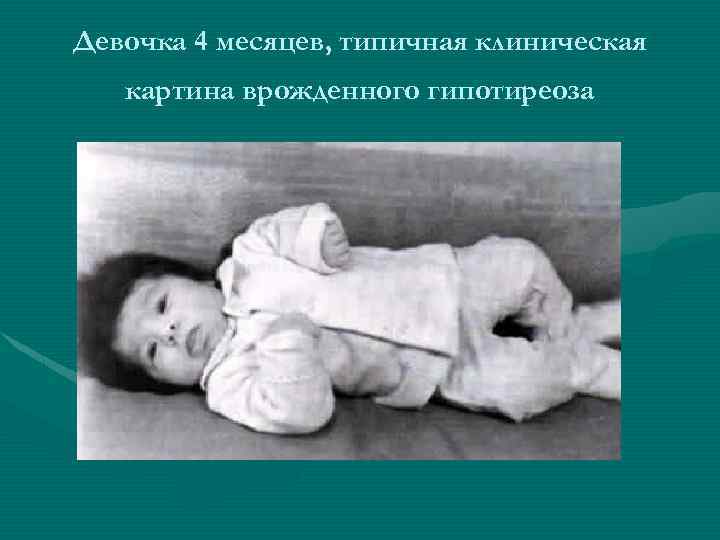 Девочка 4 месяцев, типичная клиническая картина врожденного гипотиреоза 