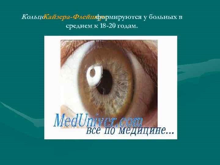 Кольцо Кайзера-Флейшера формируются у больных в среднем к 18 -20 годам. 