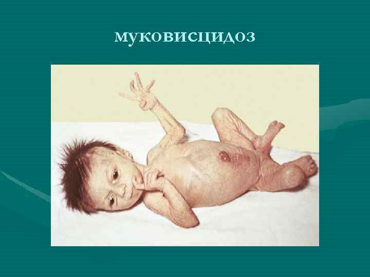 муковисцидоз 