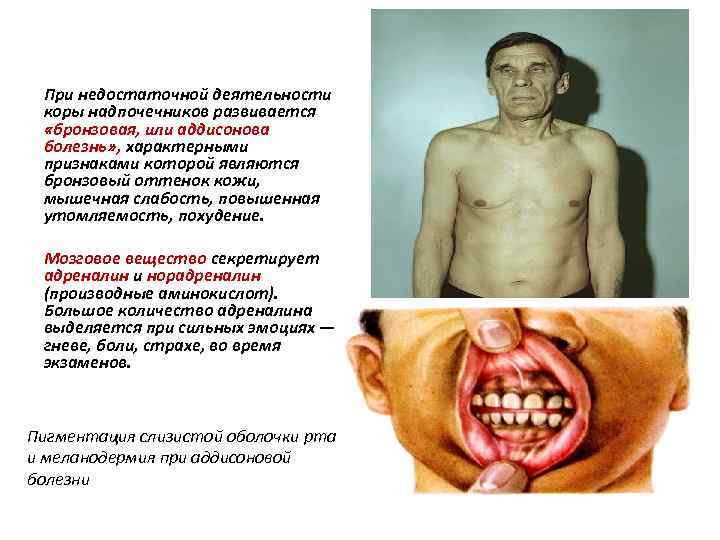 При недостаточной деятельности коры надпочечников развивается «бронзовая, или аддисонова болезнь» , характерными признаками которой