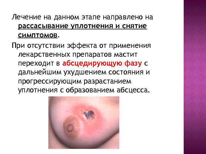 Лечение на данном этапе направлено на рассасывание уплотнения и снятие симптомов. При отсутствии эффекта