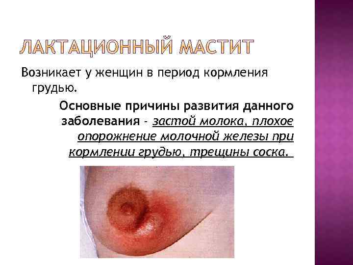 Возникает у женщин в период кормления грудью. Основные причины развития данного заболевания - застой