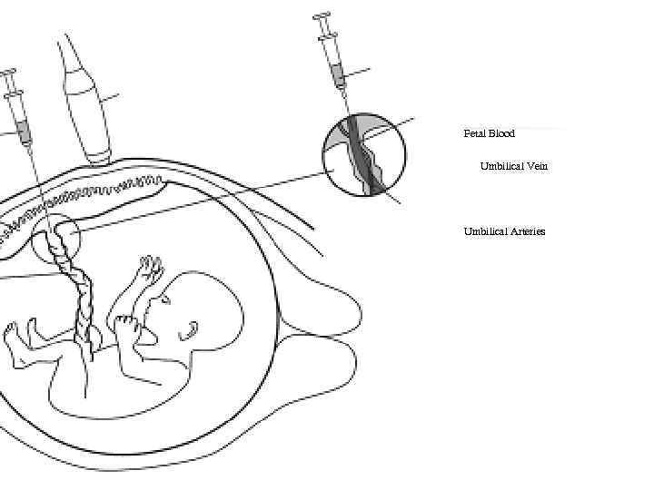 Ultrasound Probe Fetal Blood Umbilical Vein Fetal Blood Placenta Umbilical Arteries Umbilical Cord Uterine