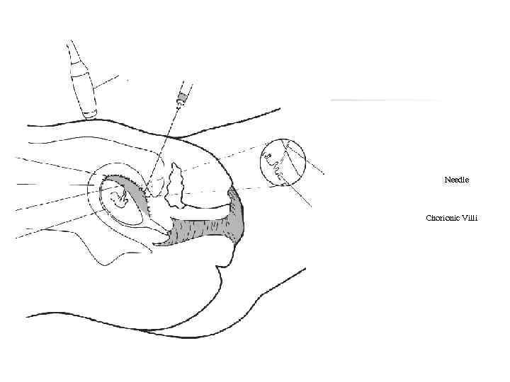 Ultrasound Probe Chorionic Villi Uterine Wall Placenta Amniotic Fluid Needle Chorionic Villi 