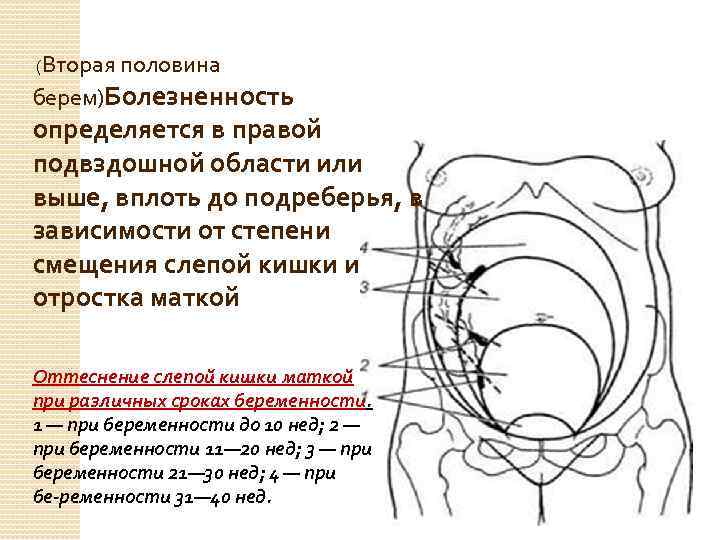  (Вторая половина берем)Болезненность определяется в правой подвздошной области или выше, вплоть до подреберья,