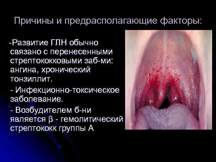 Причины и предрасполагающие факторы: -Развитие ГЛН обычно связано с перенесенными стрептококковыми заб-ми: ангина, хронический