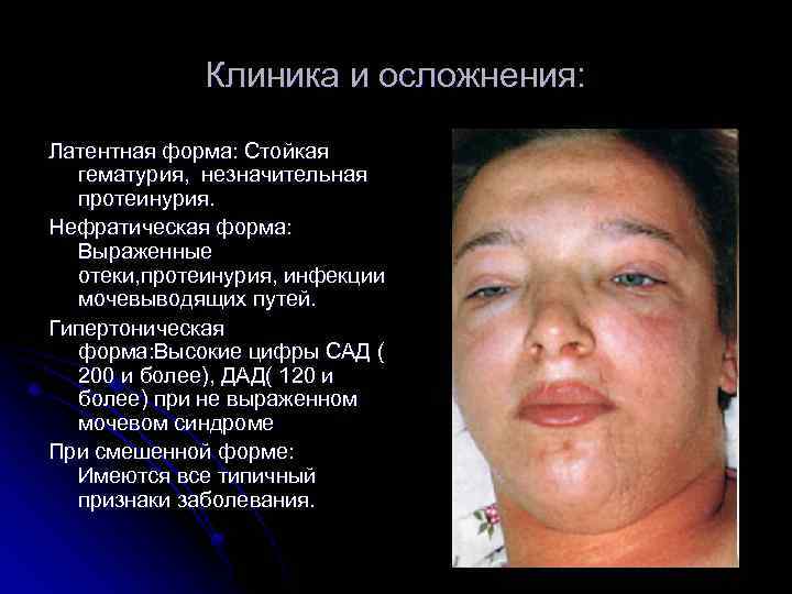 Клиника и осложнения: Латентная форма: Стойкая гематурия, незначительная протеинурия. Нефратическая форма: Выраженные отеки, протеинурия,