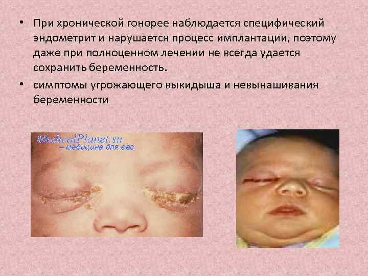  • При хронической гонорее наблюдается специфический эндометрит и нарушается процесс имплантации, поэтому даже