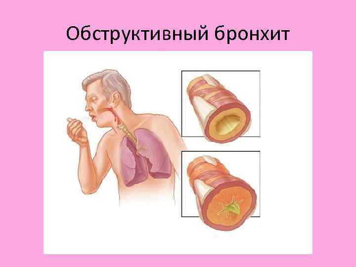 Обструктивный бронхит 