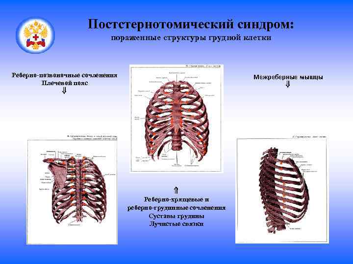 Состав грудной клетки. Постстернотомический синдром. Реберно-грудинный синдром. Реберно грудинный синдром симптомы. Деформация грудино реберного сочленения.