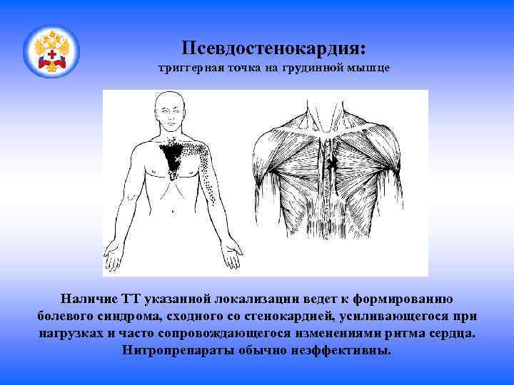Псевдостенокардия: триггерная точка на грудинной мышце Наличие ТТ указанной локализации ведет к формированию болевого