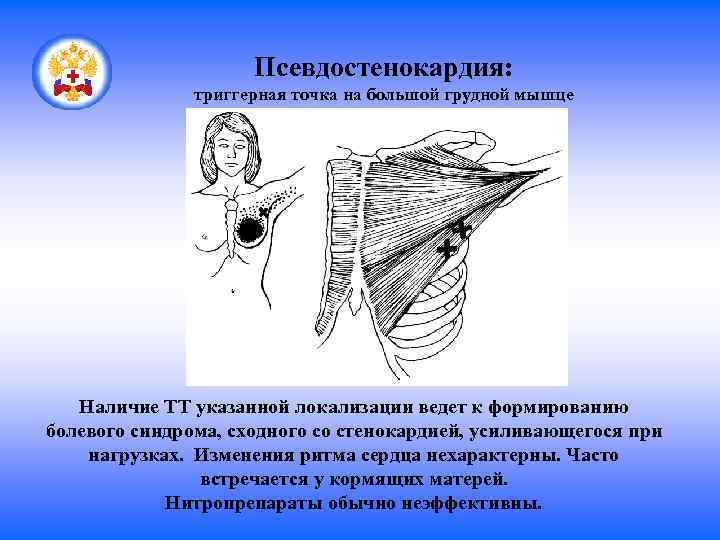 Псевдостенокардия: триггерная точка на большой грудной мышце Наличие ТТ указанной локализации ведет к формированию
