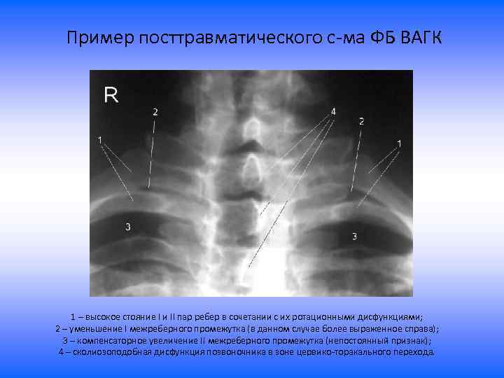 Пример посттравматического с-ма ФБ ВАГК 1 – высокое стояние I и II пар ребер