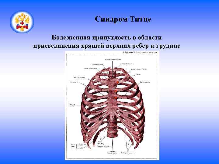 Титце синдром у детей фото