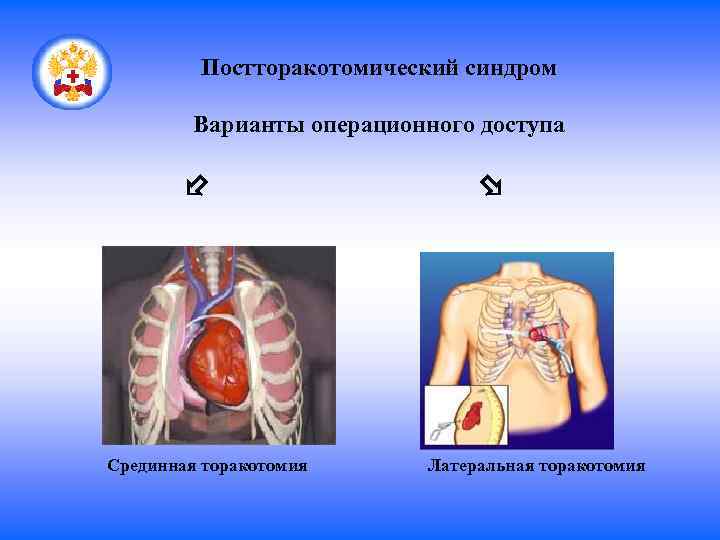 Постторакотомический синдром Варианты операционного доступа Срединная торакотомия Латеральная торакотомия 