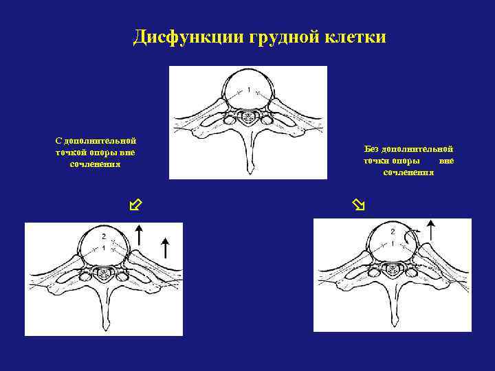 Дисфункции грудной клетки С дополнительной точкой опоры вне сочленения Без дополнительной точки опоры вне